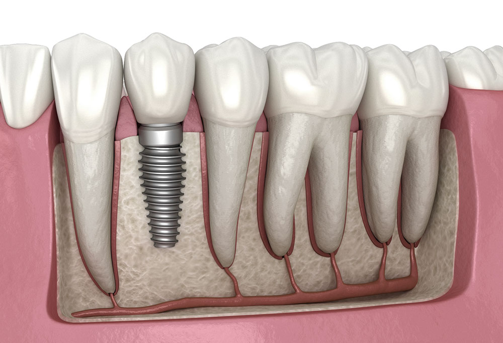 Dental Implants in South Delhi - Best Dental implants clinic in South Delhi