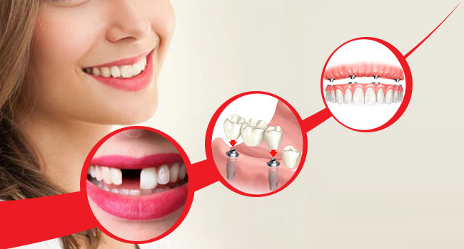Missing Teeth Treatment in Delhi, India - 32 Strong
