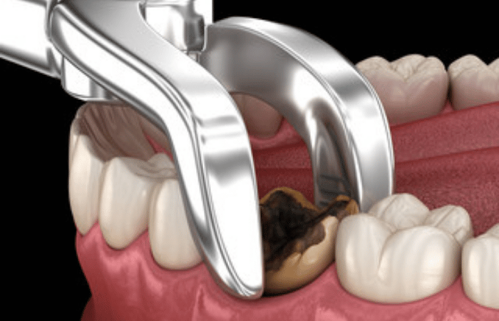 Wisdom Tooth Extraction in Delhi, India - 32 Strong