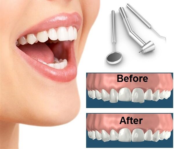 Tooth Reshaping and Dental Contouring in Delhi, India 32 Strong