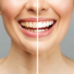 Tips for a Healthier and Whiter Smile