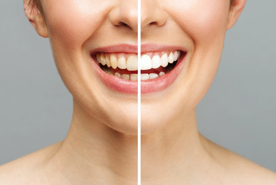 Benefits of Teeth Whitening - Teeth Whitening Treatment in South Delhi