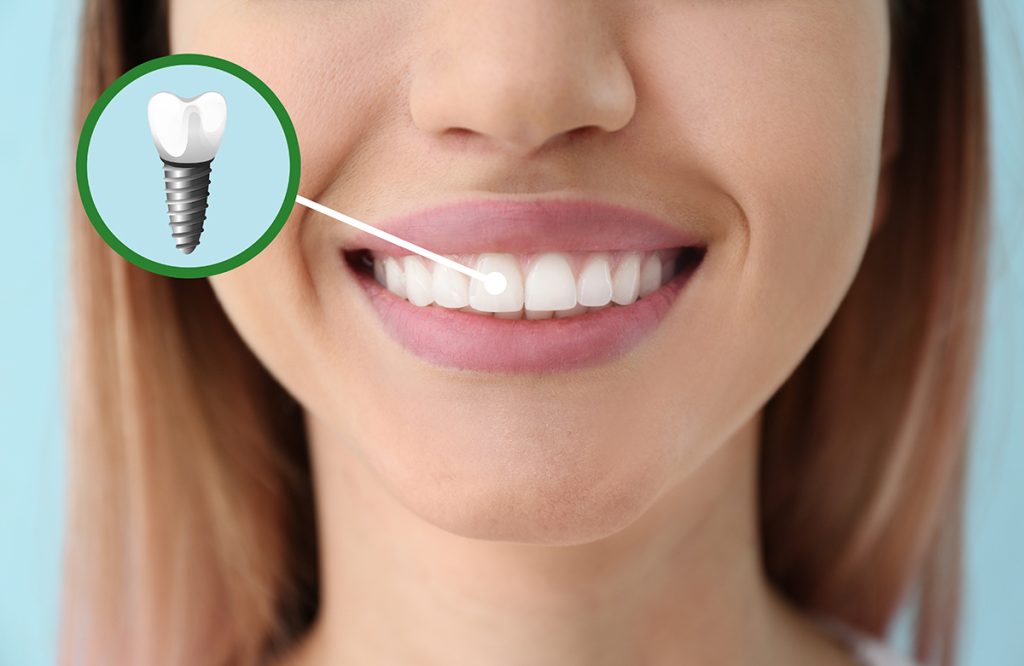 Dental Implant Cost in Delhi - 32 Strong