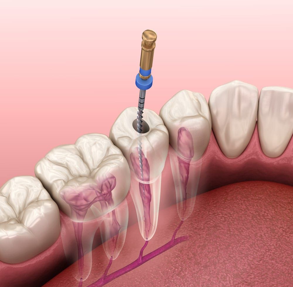 RCT Specialist in Delhi - Root Canal Treatment