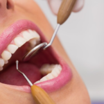 Teeth Cleaning: Myths V/S Facts