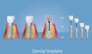 Dental Implants Cost in Delhi - 32 Strong